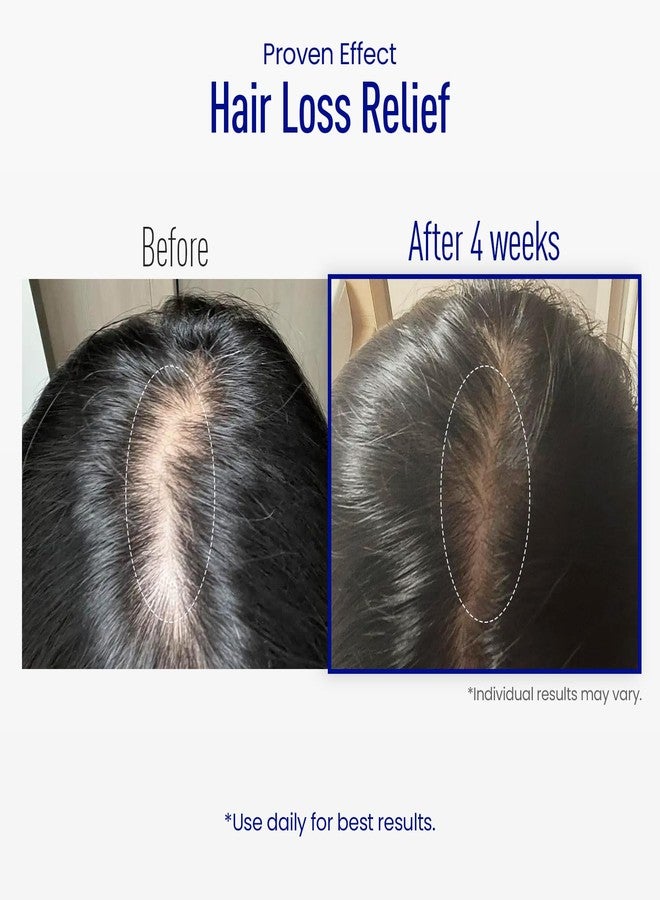 ViveLab Scalp Microneedle Serum – K-beauty Hair Growth & Scalp Treatment with Spioxyl™ 400 | Fills Hair Part Line, Strengthens Roots, Reduces Hair Thinning – 220,000 Microneedle Formula - Image 3